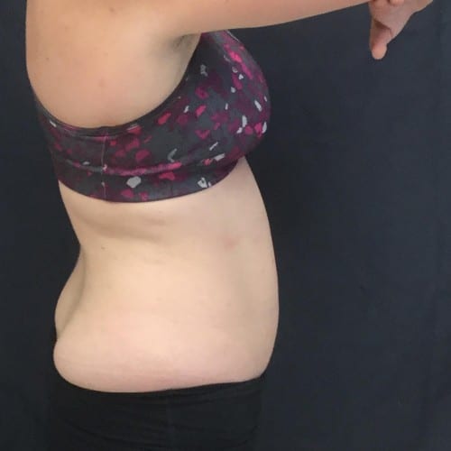 Sculpsure 03 After Photo