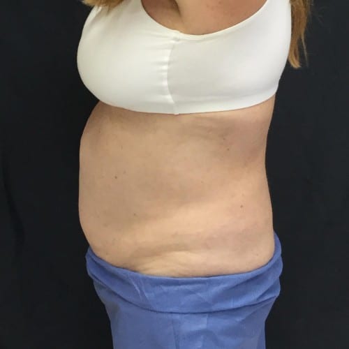 Sculpsure 04 After Photo