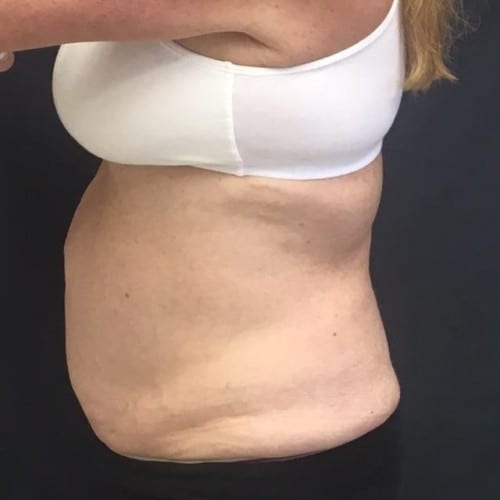 Sculpsure 04 Before Photo