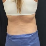 Sculpsure 04 After Thumbnail Photo