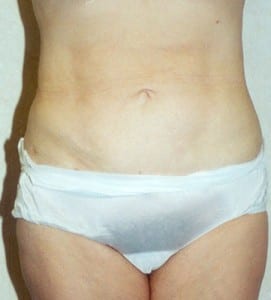 Liposuction Patient Before and After photo by Dr. Wald 