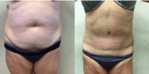 Wald Patient Tummy Tuck. Before and After