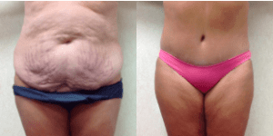 Wald Abdominoplasty Patient