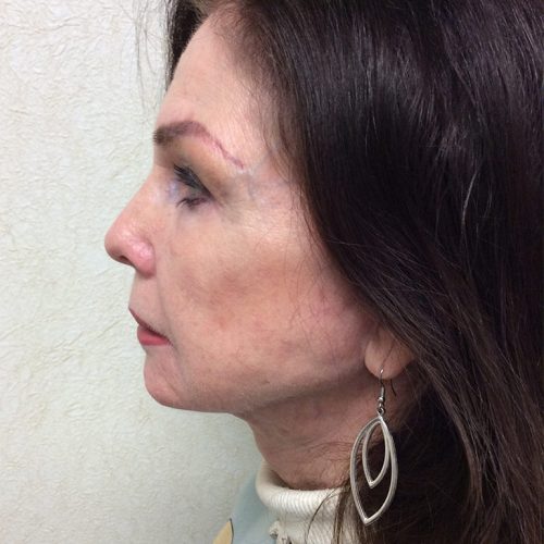 Facelift 20 After Photo