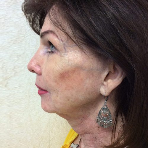 Facelift 20 Before Photo