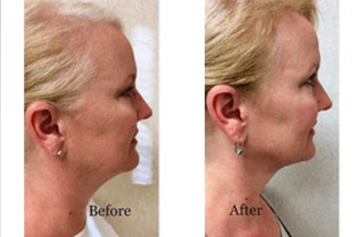 liposuction-11-before-after-img-blog