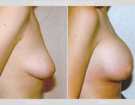 Before and After Breast Augmentation