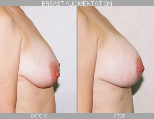 Before and After Breast Augmentation