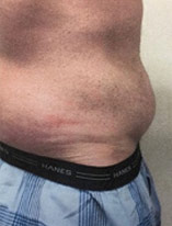 Liposuction 12 After Photo