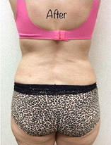 Liposuction 10 After Photo