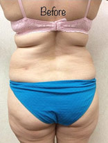 Liposuction 10 Before Photo
