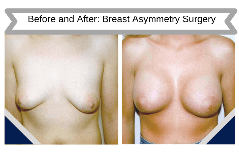 breast-lift-02b-wpcf-500x500_Blog_BA_Img