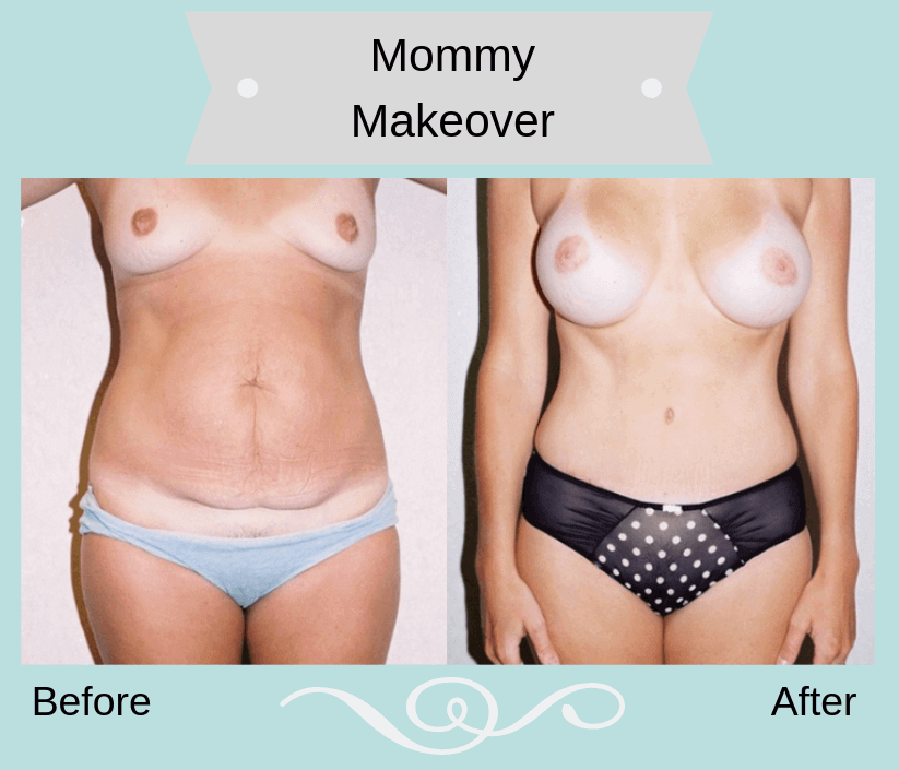 Mommy Makeover before and after photo