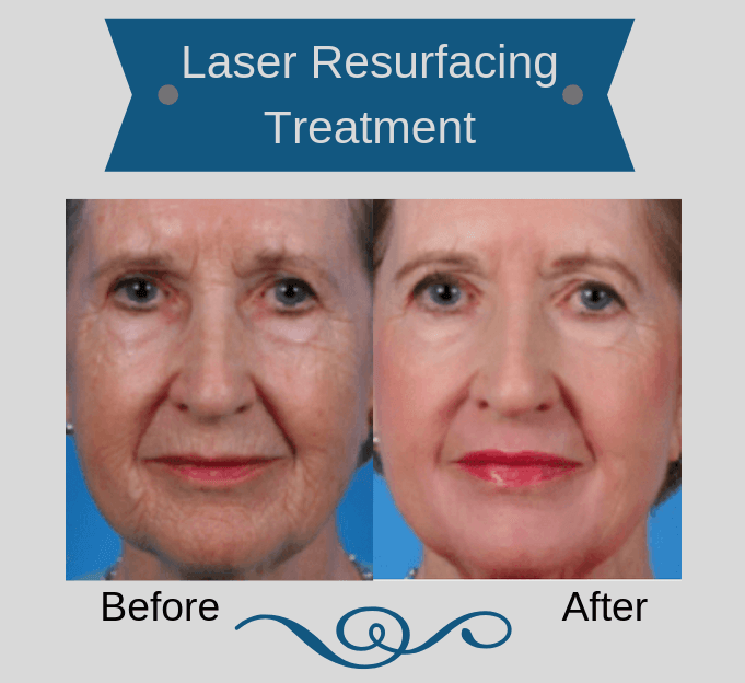 Woman before and after laser resurfacing treatment