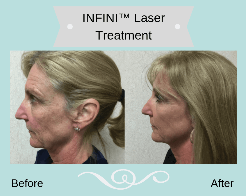 Woman before and after facial laser treatment