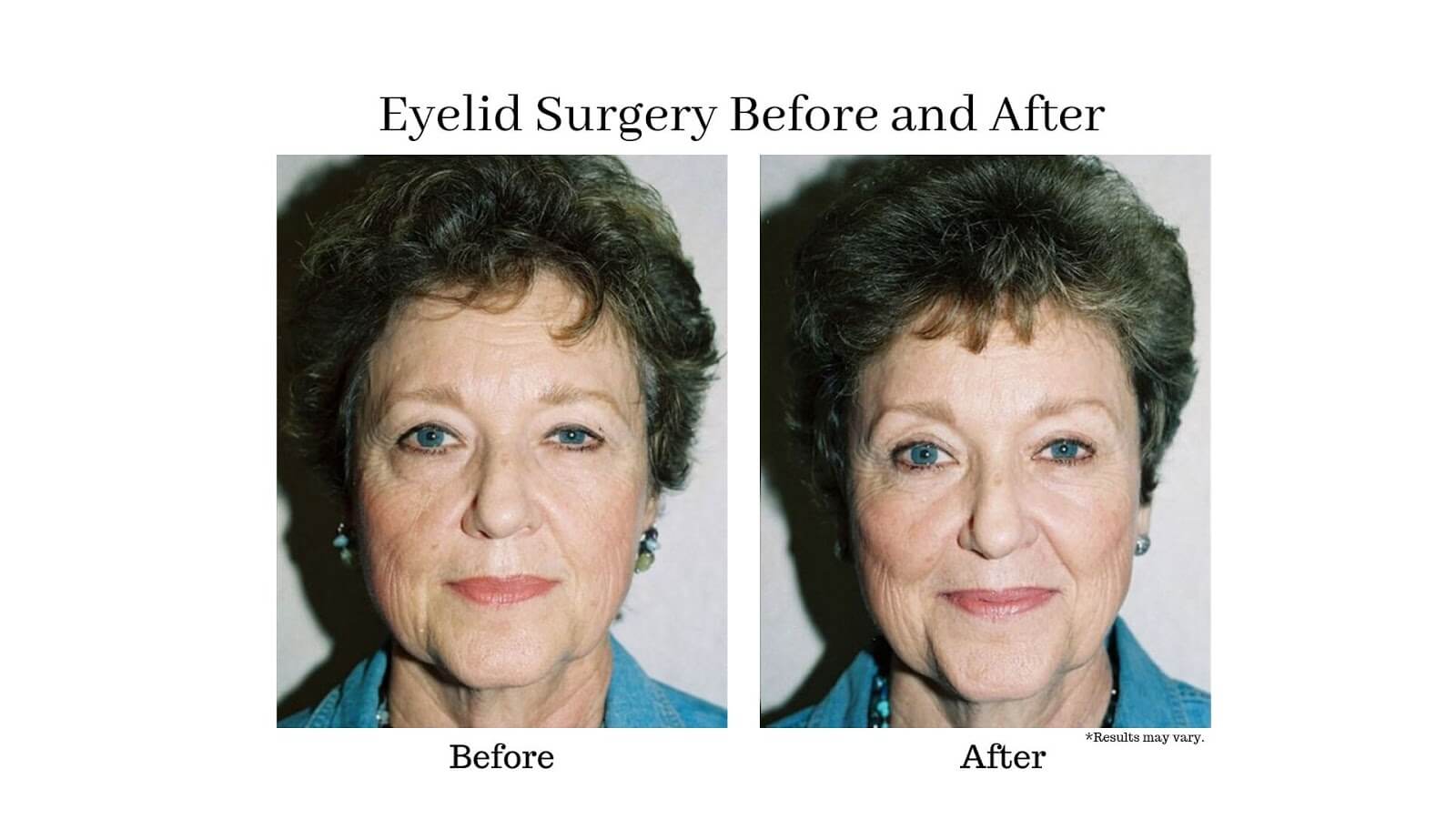  A woman before and after her eyelid surgery. Her eyes are brighter and more lively after removing excess tissue.