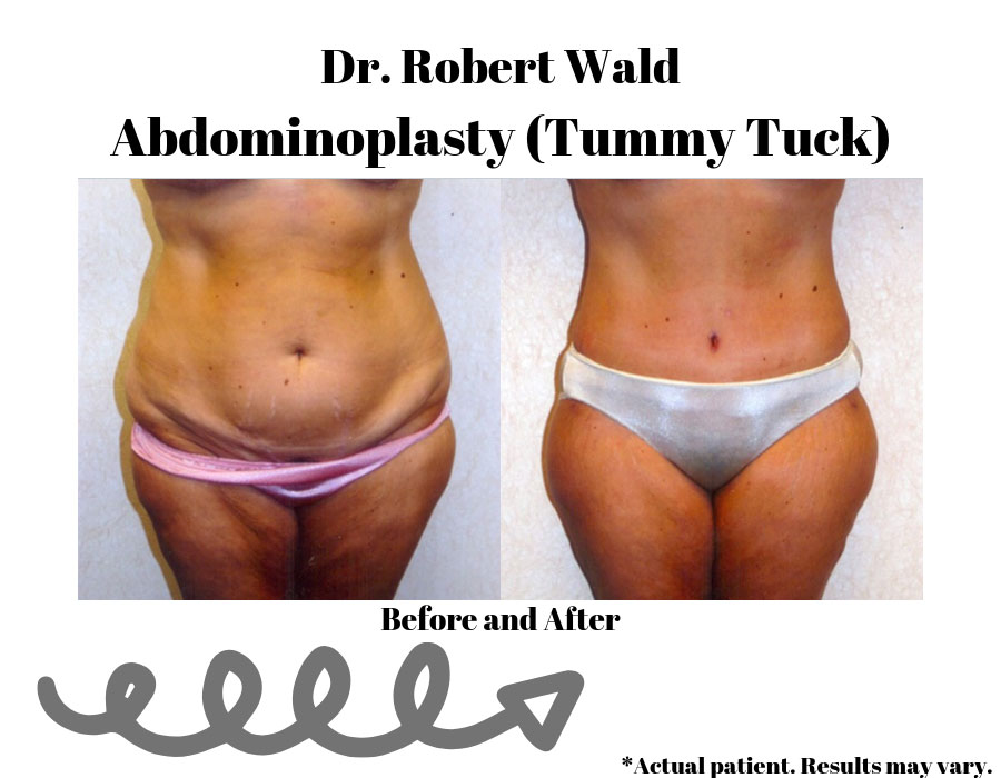 Before and after results of a tummy tuck