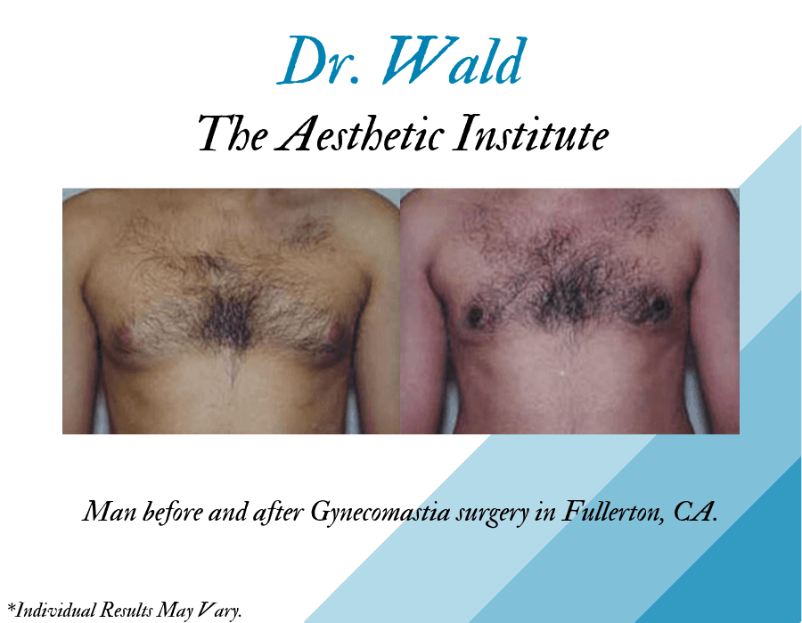 Male before and after facelift, neck lift, and bilateral lower blepharoplasty in Fullerton, CA, at the Aesthetic Institute.