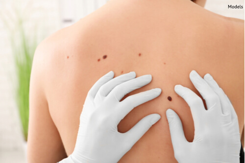 Person being examined for skin cancer-img-blog