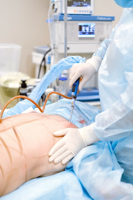 Medical professional doing liposuction on a patient