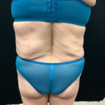 Abdominoplasty 10 After Thumbnail Photo