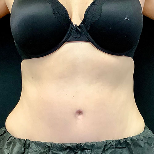 Abdominoplasty 12 After Photo