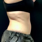 Abdominoplasty 12 After Thumbnail Photo