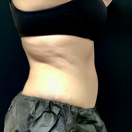 Abdominoplasty 12 After Photo