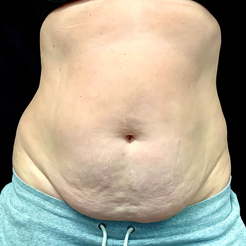 Abdominoplasty 12 Before Photo