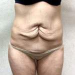 Abdominoplasty 11 Before Thumbnail Photo