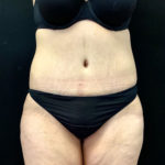 Abdominoplasty 11 After Thumbnail Photo