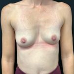 Breast Augmentation Patient 24 Before Thumbnail Photo