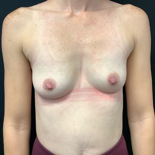 Breast Augmentation Patient 24 Before Photo