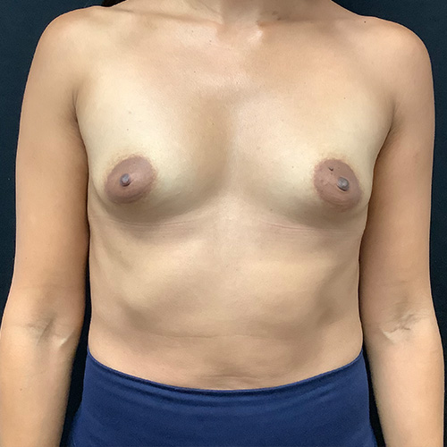 Breast Augmentation Patient 23 Before Photo