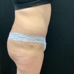 Abdominoplasty 15 After Thumbnail Photo