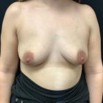 Breast Augmentation Patient 27 Before Thumbnail Photo