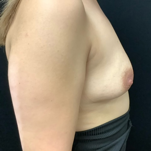 Breast Augmentation Patient 27 Before Photo