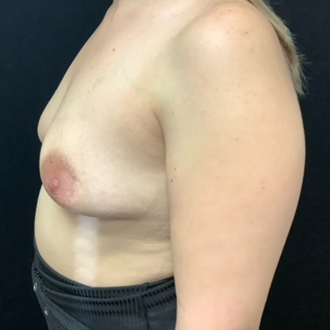 Breast Augmentation Patient 27 Before Photo