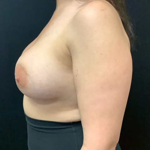 Breast Augmentation Patient 27 After Photo