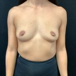 Breast Augmentation Patient 28 Before Thumbnail Photo