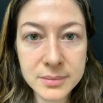 Rhinoplasty 07 After Thumbnail Photo