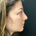 Rhinoplasty 07 After Thumbnail Photo