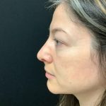 Rhinoplasty 07 After Thumbnail Photo