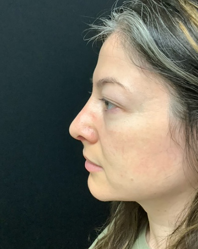 Rhinoplasty 07 After Photo