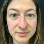 Rhinoplasty 07 Before Thumbnail Photo