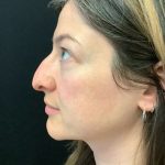 Rhinoplasty 07 Before Thumbnail Photo