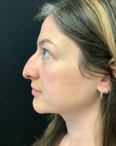 Rhinoplasty 07 Before Photo