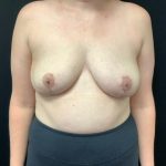 Breast Implant Removal w/ Lift Patient 02 After Thumbnail Photo