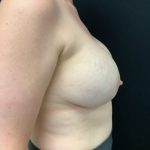 Breast Implant Removal w/ Lift Patient 02 Before Thumbnail Photo