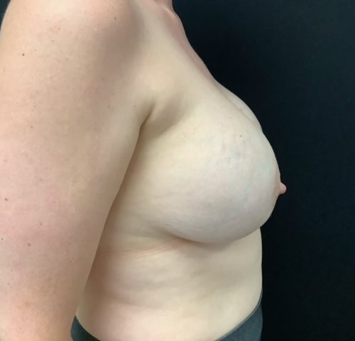 Breast Implant Removal w/ Lift Patient 02 Before Photo